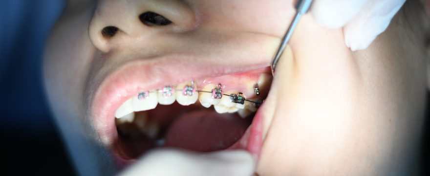 Rodzaje aparatów ortodontycznych